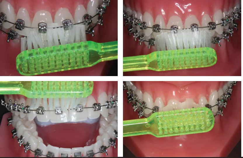 Brushing around braces from several angles with an orthodontic toothbrush.