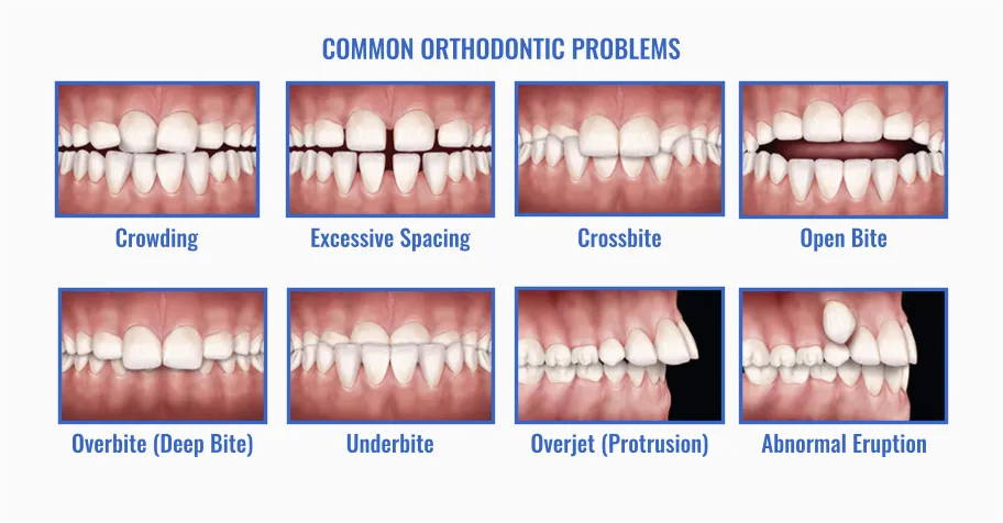Common orthodontic problems: crowding, excessive spacing, crossbite, open bite, overbite (deep bite), underbite, overjet (protrusion), and abnormal eruption.