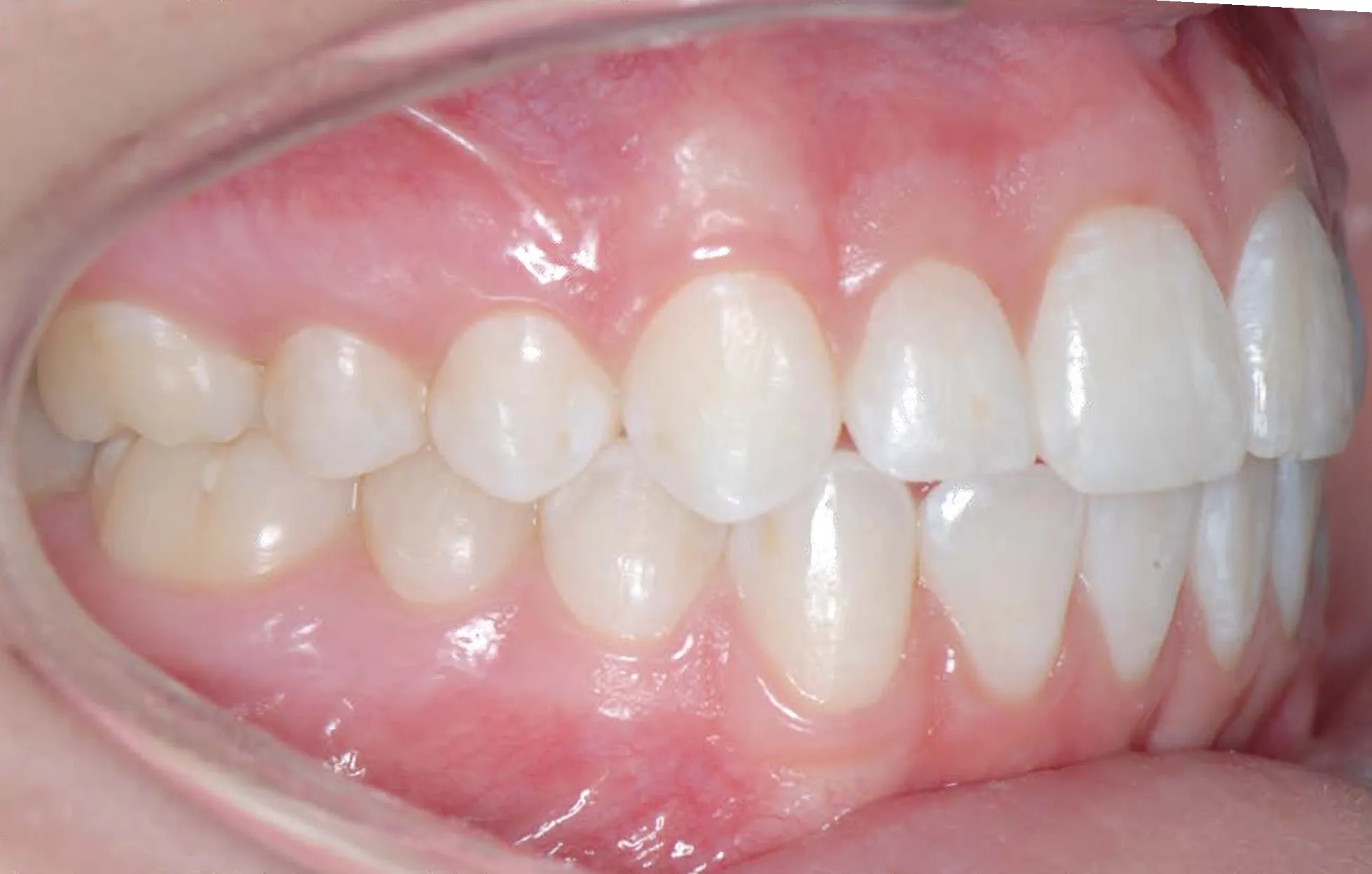 Right-side view of the teeth biting together with the cheeks retracted.